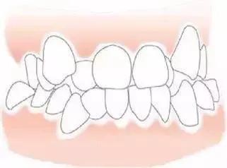 深度解析，牙齿错位是否需要拔牙决策？