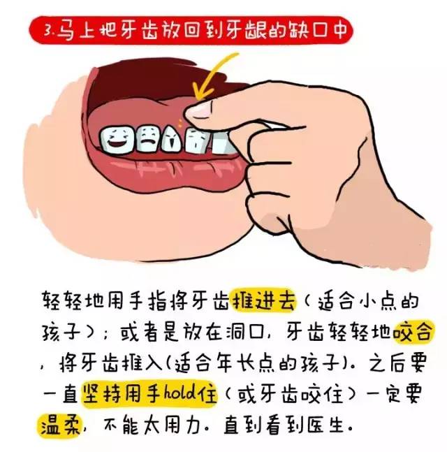 家庭急救指南，如何应对牙齿突发脱落情况