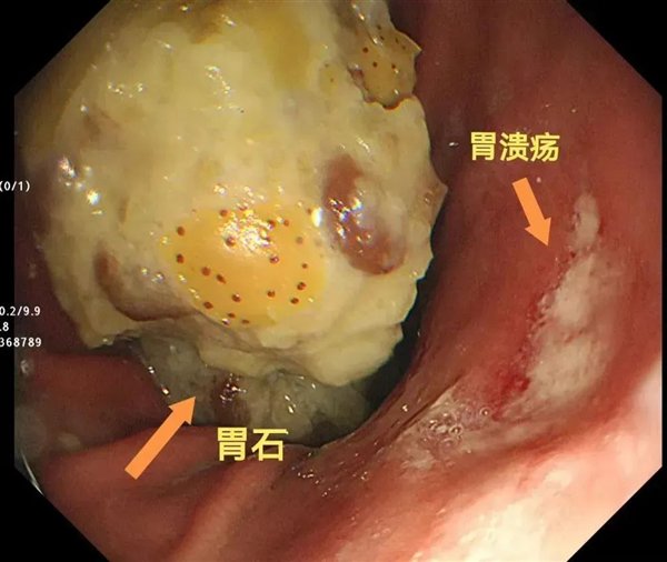 男子贪吃雪花山楂引发胃结石警示公众健康饮食反思